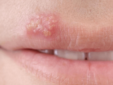 Mụn rộp môi: Nguyên nhân, triệu chứng và cách phòng ngừa