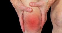 VIÊM KHỚP DẠNG THẤP HIỆN NAY - SỰ GIA TĂNG Ở NGƯỜI TRẺ
