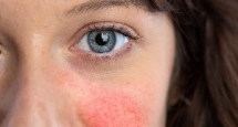 LUPUS BAN ĐỎ: ĐỐI DIỆN VỚI BỆNH TỰ MIỄN MÀ KHÔNG SỢ HÃI