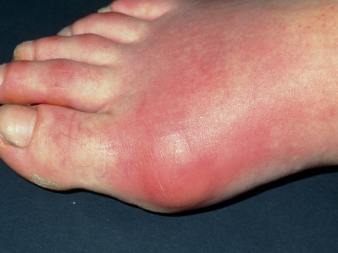 Gout - Nguyên nhân, triệu chứng và cách điều trị