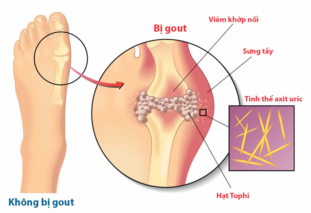 trieu-chung-benh-gout